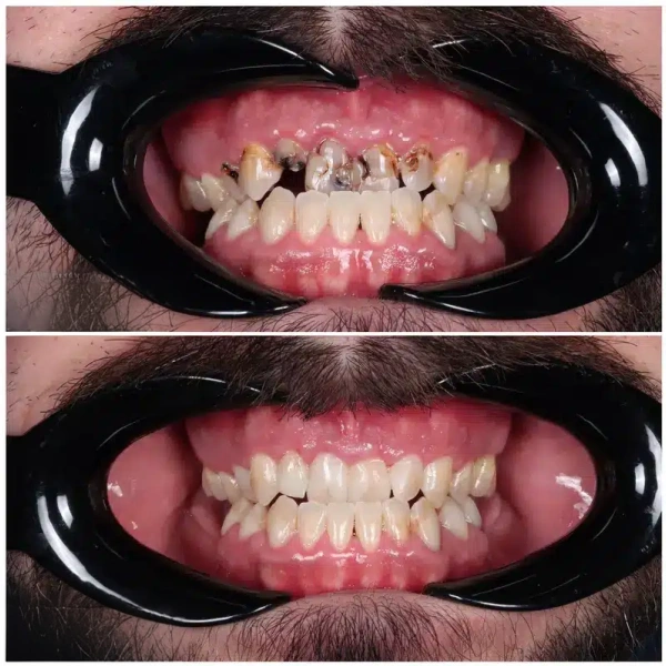 Before and after cosmetic bonding used to restore damaged teeth