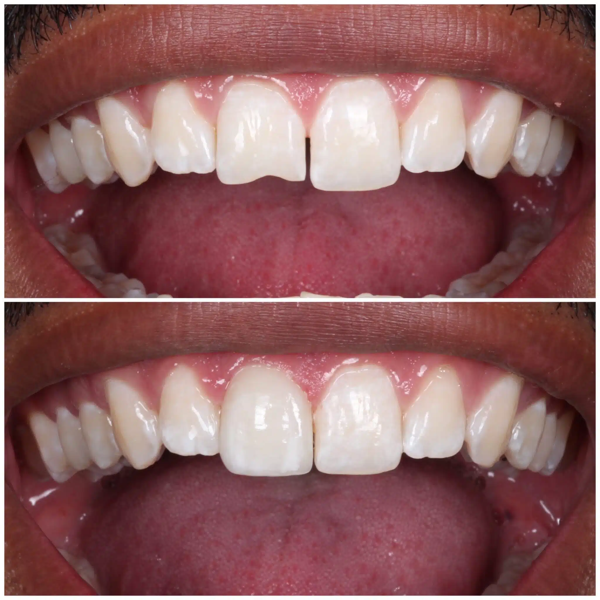 Before and after porcelain veneers improving the appearance of front teeth